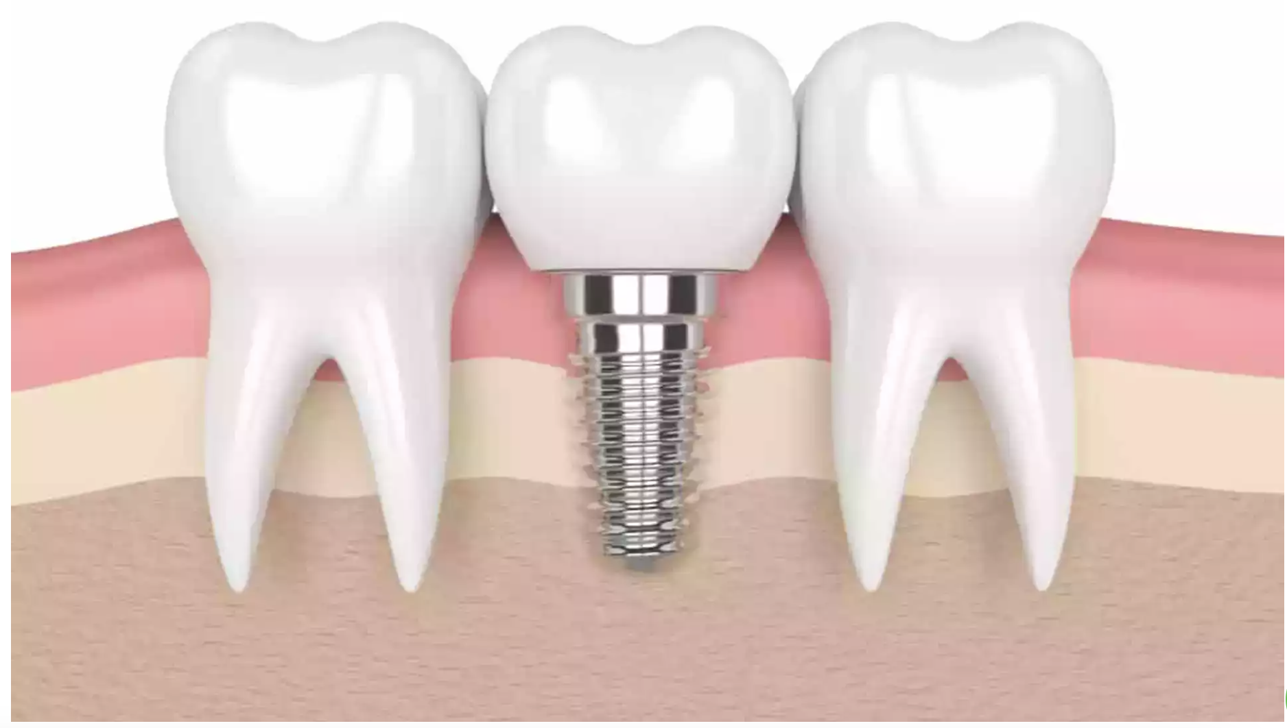 سعر زراعة الفك الكامل للأسنان
